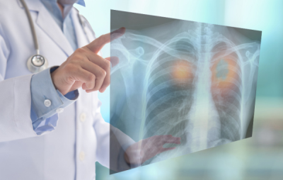 You could qualify for a preventative lung cancer screen
